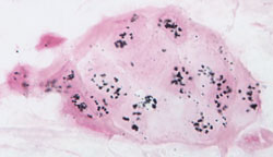 Human breast cancer biopsy tissue section where single copies (2 per normal cell) of the Her 2/neu gene were detected by EnzMet (black spots).   SISH is similar to FISH. However, EnzMet enables bright field detection, a permanent signal, and use of full-strength H&E staining for simultaneous visualization of underlying tissue morphology.  (original magnification x 400) (courtesy of Dr. Raymond R. Tubbs, Cleveland Clinic Foundation)1.