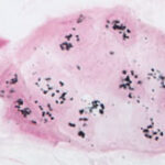 EnzMet™ SISH: Silver-Enhanced In Situ Hybridization. Human breast cancer biopsy tissue section where single copies (2 per normal cell) of the HER2/neu gene were detected by EnzMet (black spots). SISH is similar to FISH. However, EnzMet enables bright field detection, a permanent signal, and use of full-strength H&E staining for simultaneous visualization of underlying tissue morphology. Original magnification x 400; courtesy of Dr. Raymond R. Tubbs, Cleveland Clinic Foundation.