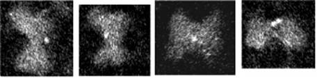 STEM images of phosphorylase kinase complex with Nanogold®-labeled d subunit. Phosphorylase-b kinase was incubated with excess exogenous calmodulin and a threshold concentration of urea to promote exchange of calmodulin for the d subunit and size exclusion-HPLC was used to remove the excess calmodulin from the enzyme. Using metabolically labeled [35S]calmodulin to allow quantification, an exchange of approximately 10% of all d subunits within 1 h was measured. The exchanged enzyme retained full catalytic activity. Calmodulins that were then derivatized with Monomaleimido-Nanogold® and exchanged under the conditions described above. Analysis of STEM images of these Nanogold®-exchanged images allowed the placement of the d subunit within the phosphorylase kinase holoenzyme. From: Traxler KW, Norcum MT, Hainfeld JF, Carlson GM. Direct Visualization of the Calmodulin Subunit of Phosphorylase Kinase via Electron Microscopy Following Subunit Exchange. J Struct Biol. 2001 Sep;135(3):231-8.