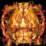 Head of a live mouse imaged by microCT following intravenous VivoVist™ administration, using a Bruker SkyScan 1276 at 13 um voxels resolution. 3D image generated and analyzed with Horos v4.0.0. Brain vessels of 50 microns or smaller were resolvable. Image kindly provided by Dr. Sean Marrelli, Department of Neurology at the McGovern Medical School at UT Health (Houston, TX).