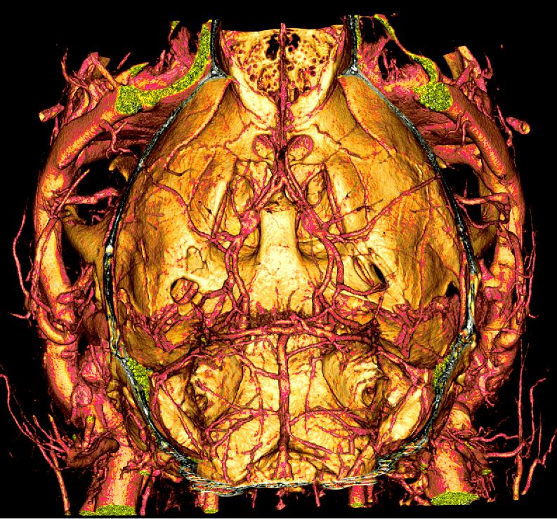 Head of a live mouse imaged by microCT following intravenous VivoVist™ administration, using a Bruker SkyScan 1276 at 13 um voxels resolution. 3D image generated and analyzed with Horos v4.0.0. Brain vessels of 50 microns or smaller were resolvable. Image kindly provided by Dr. Sean Marrelli, Department of Neurology at the McGovern Medical School at UT Health (Houston, TX).